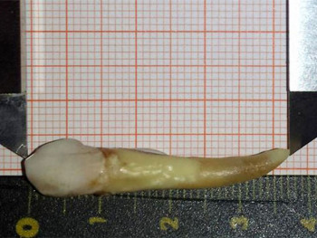 Oboren Ginisov rekord - Hrvatu izvađen zub dug 37,2 milimetra