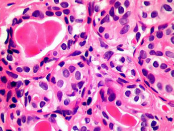 Научници открили ћелију у крви која би могла да лијечи све врсте рака (ФОТО)