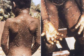 Virus pobijeđen prije 40 godina: Ubio milione, preživjeli bili unakaženi