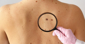Udruženje dijabetičara organizuje akciju pod nazivom ''Zaštiti kožu od sunca – spriječi melanom''